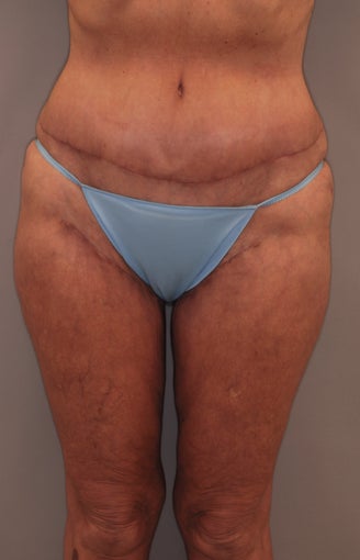 Thigh Lift