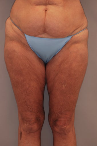 Thigh Lift