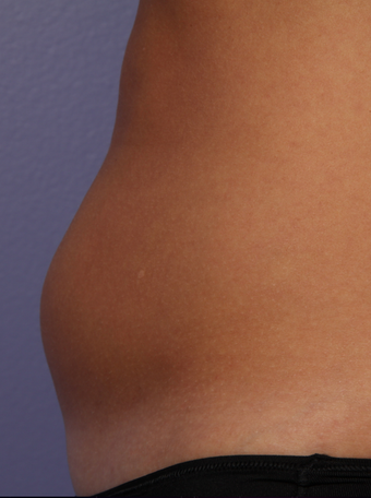 CoolSculpting by Zeltiq to abdomen