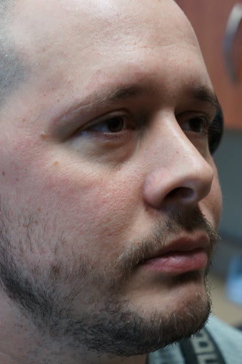 Male Liquid Eyelid Lift for Bags