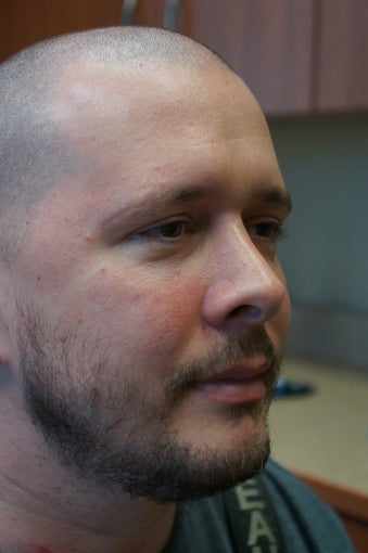 Male Liquid Eyelid Lift for Bags