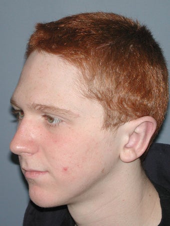 Otoplasty/Ear Surgery