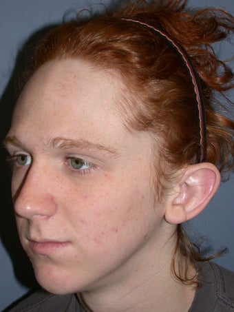 Otoplasty/Ear Surgery