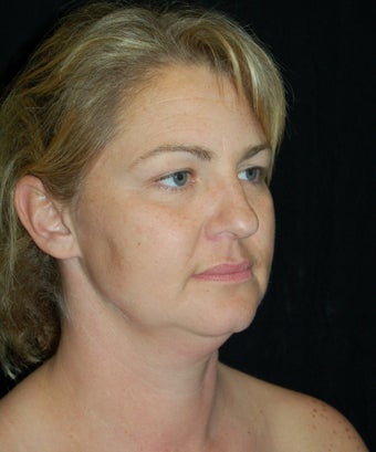 Cheek Fat Pad Removal