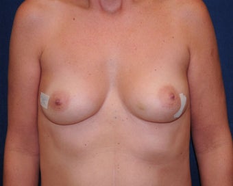 immediate bilateral mastectomy and immediate reconstruction 