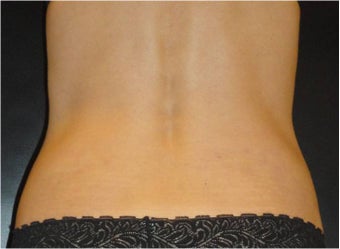SmartLipo MPX