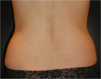 SmartLipo MPX