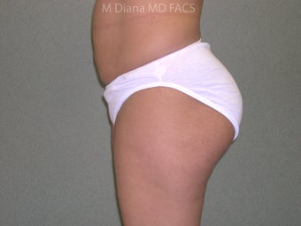 SmartLipo