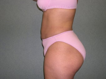 SmartLipo
