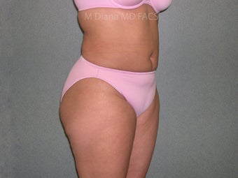 SmartLipo