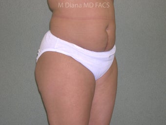 SmartLipo