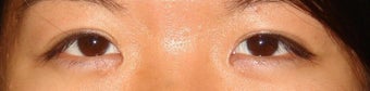 Bilateral Asian Eyelid Surgery