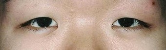 Bilateral Asian Eyelid Surgery