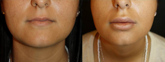 Two weeks after a dermal fat graft to both upper and lower lips.