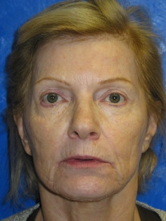 Total FX Laser (active and Deep FX)