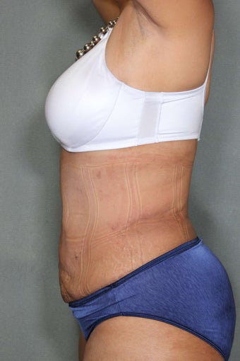51 Year Old Female Treated for UnWanted Fat With SmartLipo and Vaser Laser