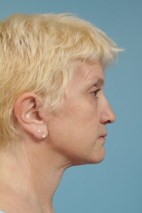 Neck Lift