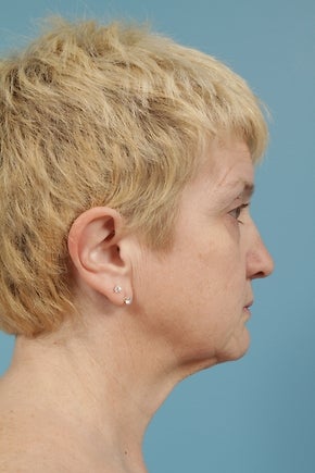 Neck Lift