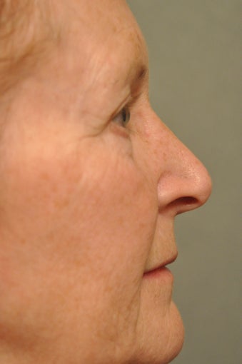 66 year old female treated for sun damage and wrinkles
