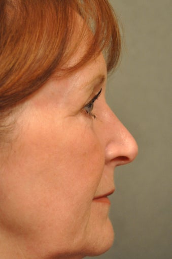 66 year old female treated for sun damage and wrinkles