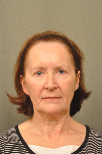 66 year old female treated for sun damage and wrinkles