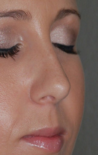 Rhinoplasty - Refine tip, Widen Dorsum