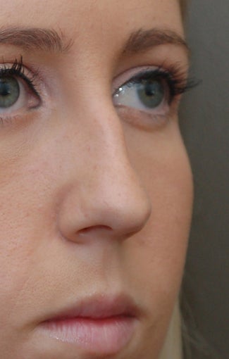 Rhinoplasty - Refine tip, Widen Dorsum