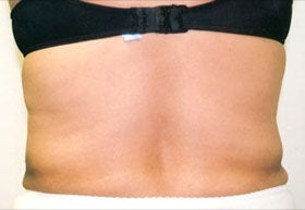 Liposuction