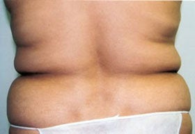 Liposuction