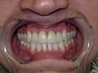 45 year old male patient - cosmetic veneers