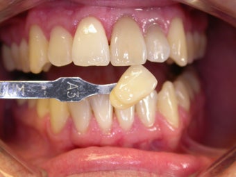45 year old male patient - cosmetic veneers