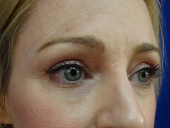 Lower eyelid hyaluronic acid (Restylane)