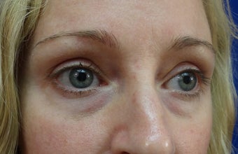 Lower eyelid hyaluronic acid (Restylane)