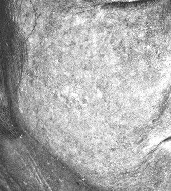 Fraxel re:pair (repair) CO2 laser resurfacing for pigmentation