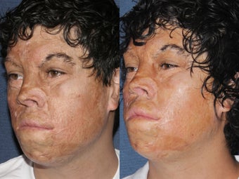 Before & After Laser Resurfacing