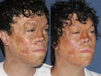 Before & After Laser Resurfacing