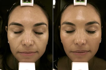 38 year old woman treated with Restylane for infraorbital hollows and nasolabial folds