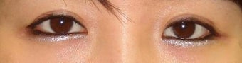 Revision Bilateral Asian Eyelid Surgery 