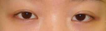 Revision Bilateral Asian Eyelid Surgery 