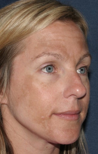 Before & After Botox in San Diego 