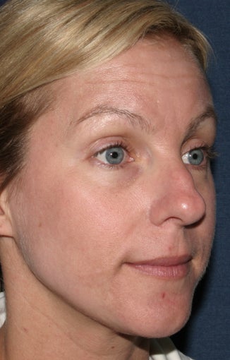 Before & After Botox in San Diego 
