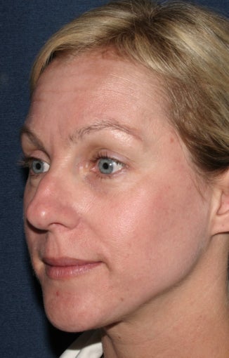 Before & After Botox in San Diego 
