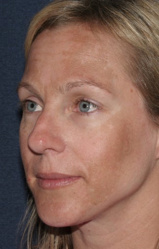Before & After Botox in San Diego 