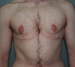 38-Year-Old Male Breast Reduction