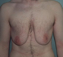 38-Year-Old Male Breast Reduction