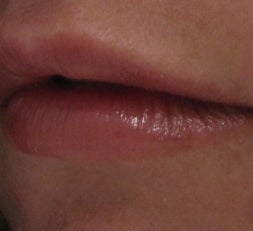 Lip Enhancement with Juvederm Ultra