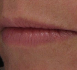 Lip Enhancement with Juvederm Ultra