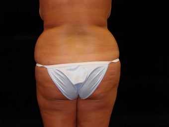 Brazilian Buttocks Lift