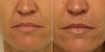 Smile lines treated with Restylane