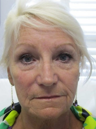 Wrinkle treatment for woman for lower face